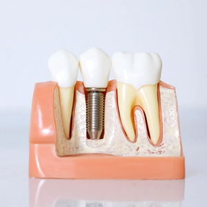 Can Emergency Dentists Perform Dental Implants? | Newark, NJ