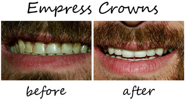 Dental Crowns 3
