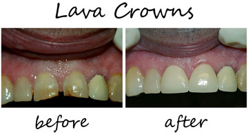 Dental Crowns 5